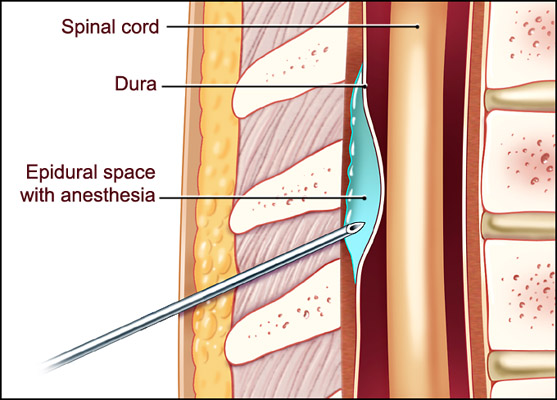 epidural space