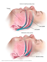 diagram of sleep apnea