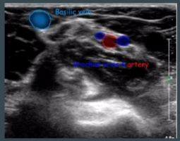 Imaging of PICC placement