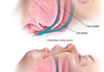 diagram of sleep apnea