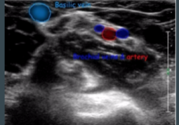 Imaging of PICC placement